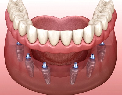 3D illustration of an implant denture