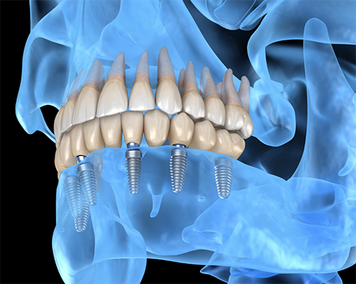 Illustrated x-ray of implant dentures on both arches