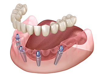 Illustration of implant denture on four implants