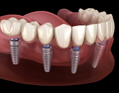 3D illustration of an implant denture with black background