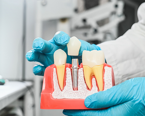 Dentist putting a crown over a model of a dental implant