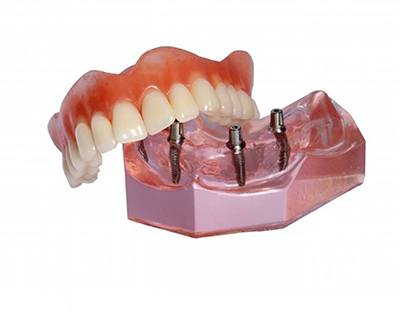 Implant retained denture