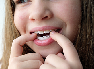 Teenage girl putting Invisalign over her teeth