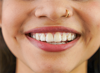 Closeup of woman smiling with Invisalign on her teeth
