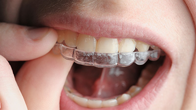 Closeup of patient placing Invisalign tray