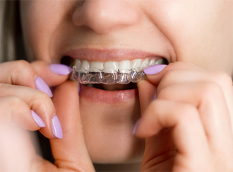 Woman placing Invisalign over her upper teeth