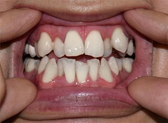 Closeup of crowded teeth