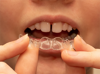 Closeup of clear aligner being placed over gapped teeth