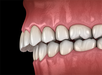 Illustrated overbite