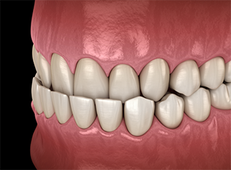 Illustrated underbite
