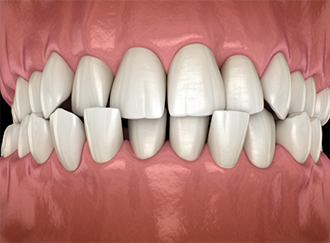 Illustrated crossbite