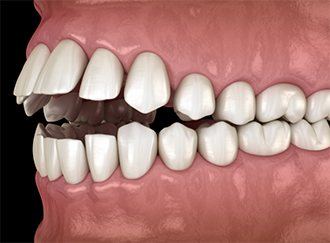 Illustrated open bite