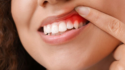 a person showing signs of gum disease