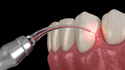 a 3D illustration of gum recontouring