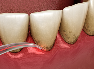 Illustration of laser gum disease treatment