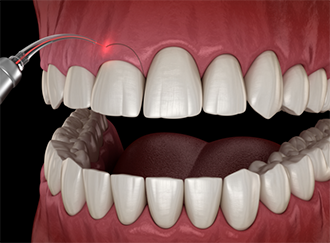 Illustration of laser gum recontouring