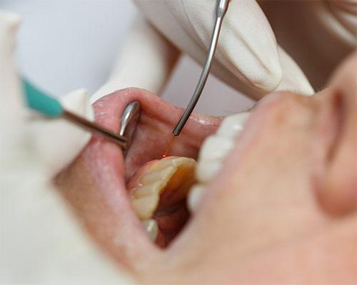 Close-up of a dental patient getting laser treatment