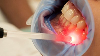 Laser periodontal treatment works by removing damaged gum tissue with a soft tissue laser