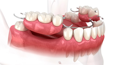 Illustration of a partial denture