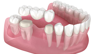 Illustration of a dental bridge
