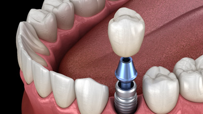 Illustration of a single dental implant