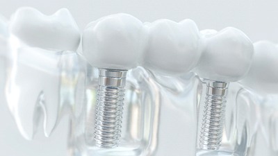 implant-supported bridge
