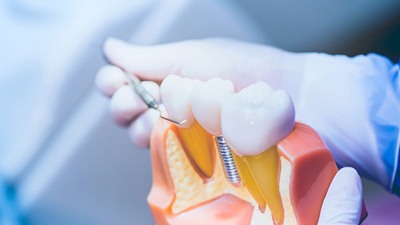 dentist explaining implant