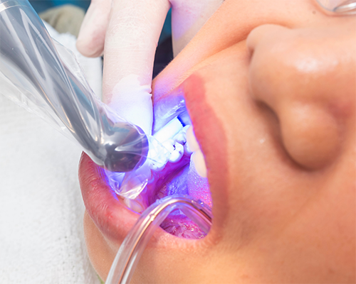 Ultraviolet light helping a dentist examine a mouth