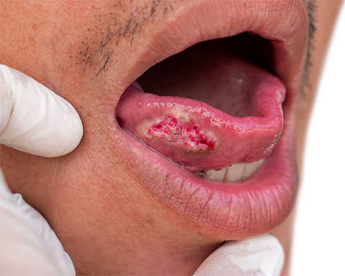 White and red patch under a person's tongue
