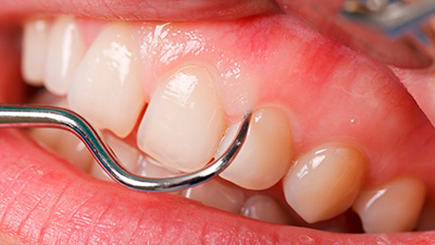 Closeup of smile during periodontal treatment