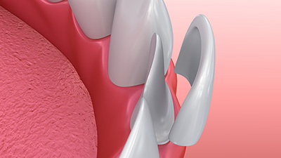 Animation of porcelain veneer placement
