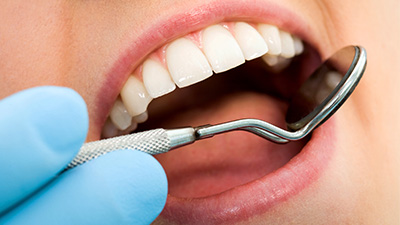 Closeup of health smile with dental sealants