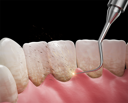 Illustration of gum disease treatment