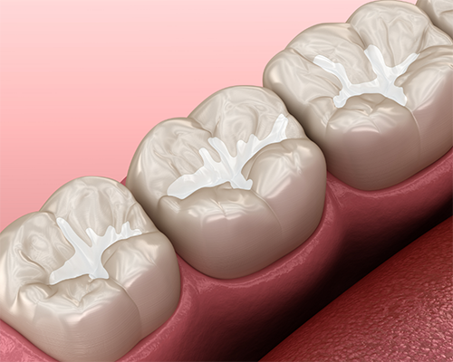 Illustration of teeth with sealants