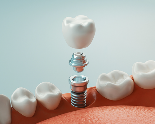Illustration of dental implant replacing missing tooth