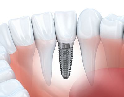 Animation of implant supported dental crown
