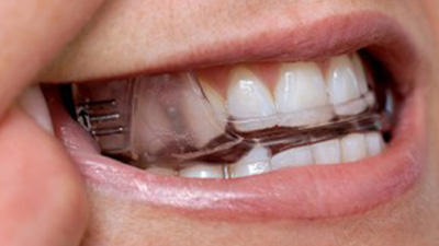 Closeup of patient using oral appliance