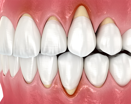 Illustration of receding gums
