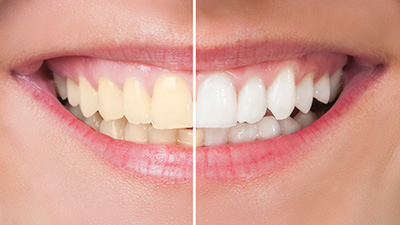 Closeup of smile half before and half after whitening