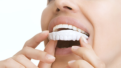 Woman placing at-home whitening tray