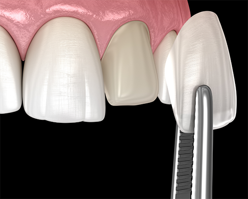 Tweezers placing a veneer on a tooth