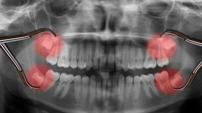 X-rays of smile