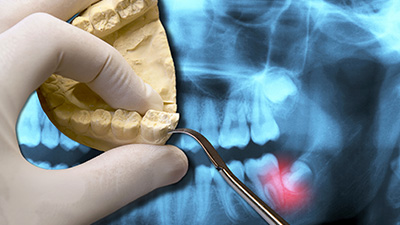 Model smile and x-ray of tooth prior to extraction