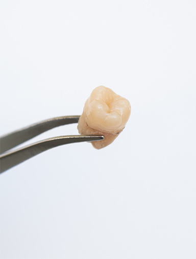 Extracted tooth held in tweezers