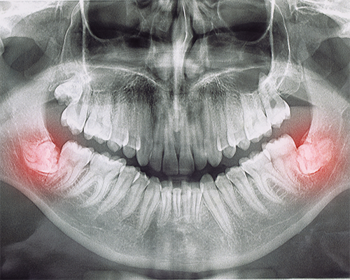 X-ray of teeth with wisdom teeth highlighted