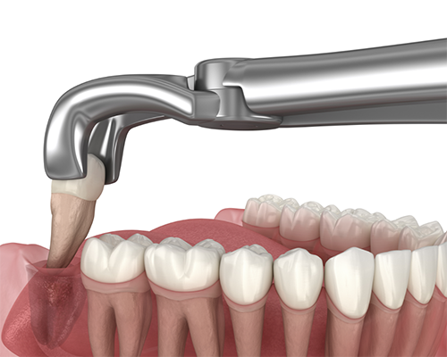 Illustration of wisdom tooth being extracted