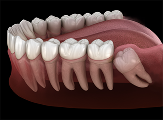 Illustration of an impacted wisdom tooth