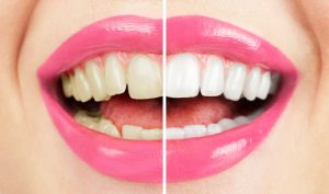 Get a whiter smile using these methods.