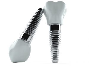 dental implants in Irving