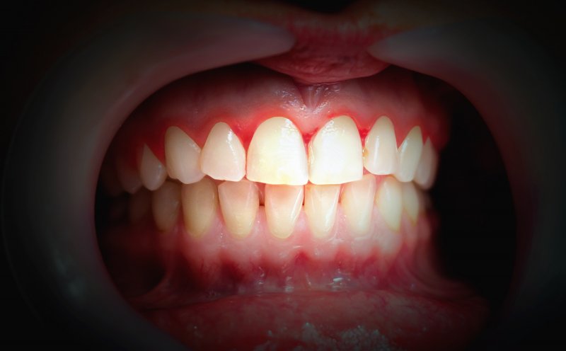 Image of mouth with red, bleeding gums; gum disease